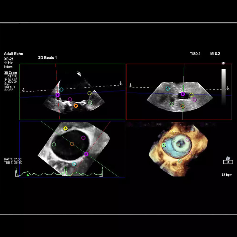 Ультразвуковая система экспертного класса Philips Affiniti CVx